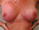 Patient # 87040 After Photo # 2