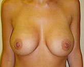 Patient # 70387 After Photo # 2