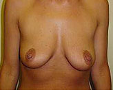 Patient # 70387 Before Photo # 1