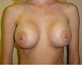 Patient # 30813 After Photo # 2