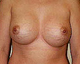 Patient # 61387 After Photo # 2