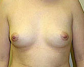 Patient # 61387 Before Photo # 1