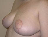 Patient # 30907 After Photo # 4