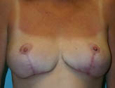 Patient # 58782 After Photo # 2
