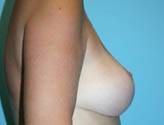 Patient # 58782 After Photo # 6