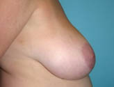 Patient # 58782 Before Photo # 5