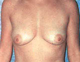 Patient # 46343 Before Photo # 1