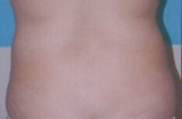 Patient # 48081 Before Photo # 1