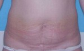 Patient # 22296 Before Photo # 1