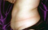 Patient # 43905 Before Photo # 1