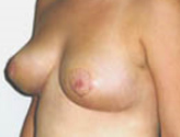Patient # 47006 After Photo # 2