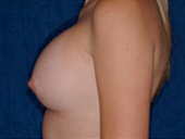 Patient # 15819 After Photo # 4