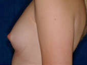 Patient # 15819 Before Photo # 3
