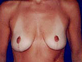 Patient # 63572 Before Photo # 1