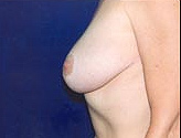 Patient # 54806 After Photo # 4