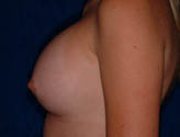 Patient # 85074 After Photo # 2