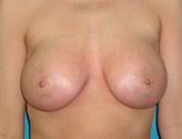 Patient # 83127 After Photo # 2