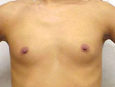 Patient # 15937 Before Photo # 1