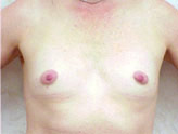 Patient # 63642 Before Photo # 1