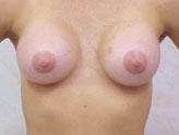 Patient # 86384 After Photo # 2
