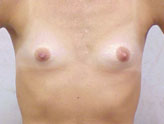 Patient # 86384 Before Photo # 1