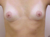 Patient # 30556 Before Photo # 1