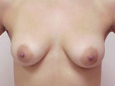 Patient # 57509 Before Photo # 1