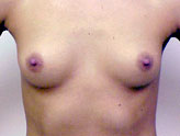 Patient # 59513 Before Photo # 1