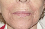 Patient # 15826 Before Photo # 1