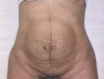Patient # 90076 Before Photo # 1
