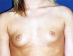 Patient # 78447 Before Photo # 1