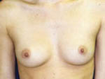 Patient # 39943 Before Photo # 1