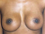 Patient # 99232 After Photo # 2