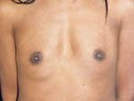 Patient # 99232 Before Photo # 1