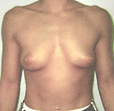 Patient # 36818 Before Photo # 1