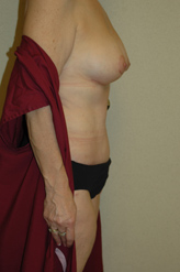 Patient # 61345 After Photo # 4