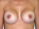 Patient # 65559 After Photo # 2
