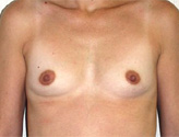 Patient # 65559 Before Photo # 1