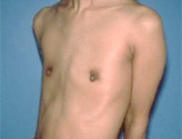 Patient # 82340 Before Photo # 1