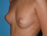 Patient # 10576 Before Photo # 1