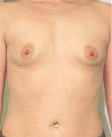 Patient # 95662 Before Photo # 1