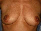 Patient # 93117 After Photo # 2