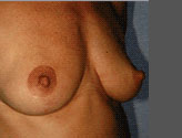 Patient # 93117 After Photo # 4