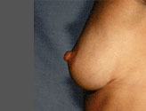 Patient # 93117 After Photo # 6