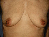 Patient # 93117 Before Photo # 1