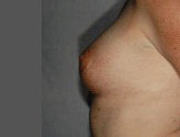Patient # 60902 After Photo # 6