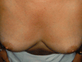Patient # 24582 After Photo # 4