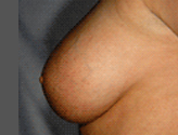 Patient # 24582 Before Photo # 7