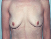 Patient # 35434 Before Photo # 1
