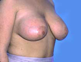 Patient # 61327 After Photo # 4